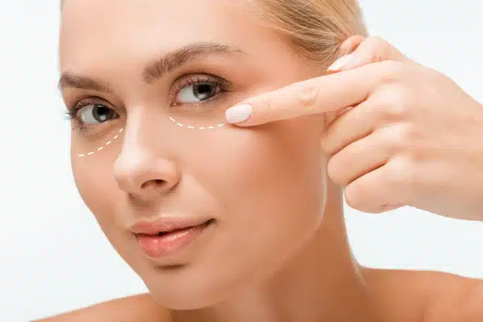 A woman gently touches the skin near the corner of her eye with her finger. There are dotted lines drawn under her eyes, suggesting either a cosmetic procedure or skincare treatment area. She has light-colored eyes and smooth, clear skin.