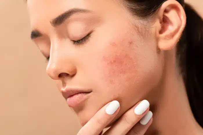 A person with closed eyes and dark hair pulled back, showing a close-up of their face. The person's skin has visible acne or blemishes on the cheek, hinting at the potential benefits of Restylane for acne scars. They are gently touching their chin with a hand that has white-painted nails, set against a neutral background.