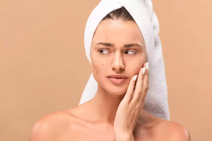 A woman with a white towel wrapped around her wet hair examines her face with a concerned expression. She has several blemishes on her cheeks and forehead, possibly considering dermal fillers for acne scars. The background is a plain beige color.