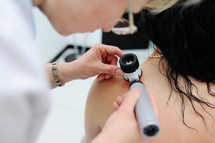 A close-up image of a dermatologist examining the skin on a patient's shoulder using a dermatoscope. The patient has black hair and is sitting while the dermatologist, wearing glasses and a white coat, carefully inspects the skin.