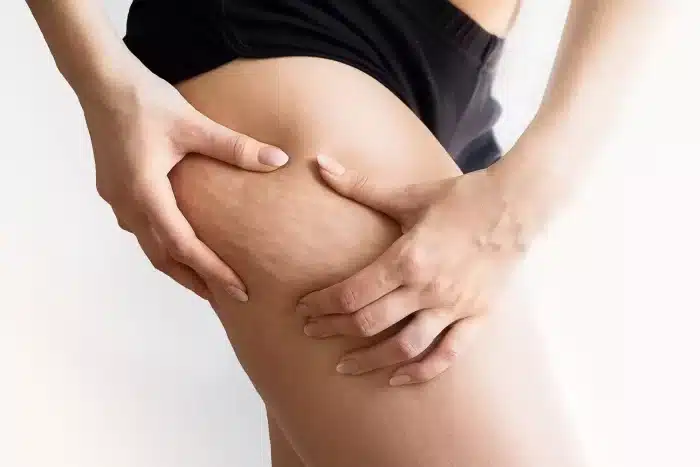 Close-up of a person pinching the skin on their upper thigh, showing visible cellulite. The person is wearing black shorts, and the background is blurred and neutral, highlighting the contrast often seen in discussions about lipedema vs cellulite.
