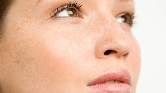 Teosyal filler treatment.