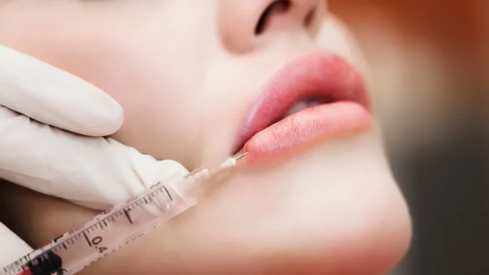 Lip fillers.