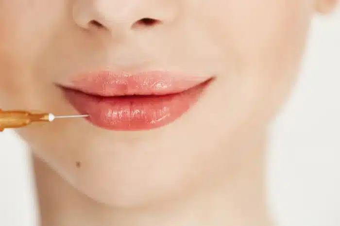Lip fillers.